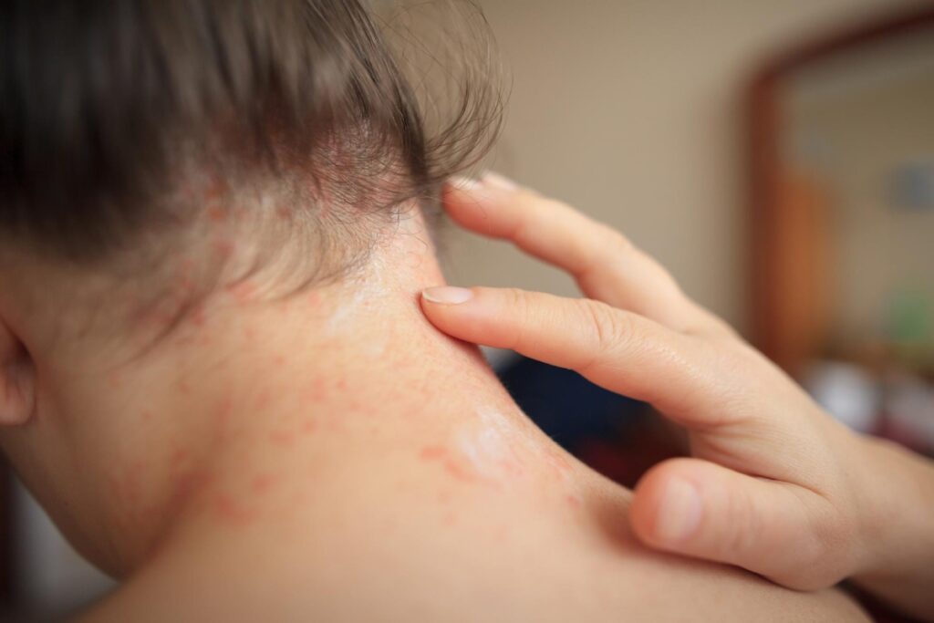 Home Remedies For Heat Rashes