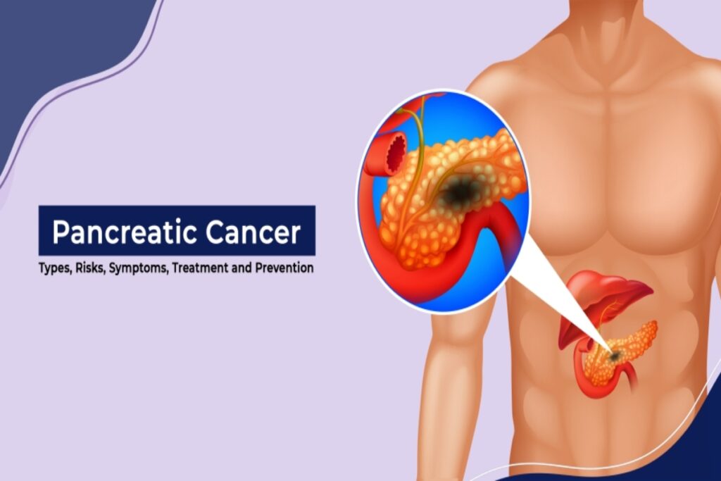 Pancreatic Cancer Symptoms