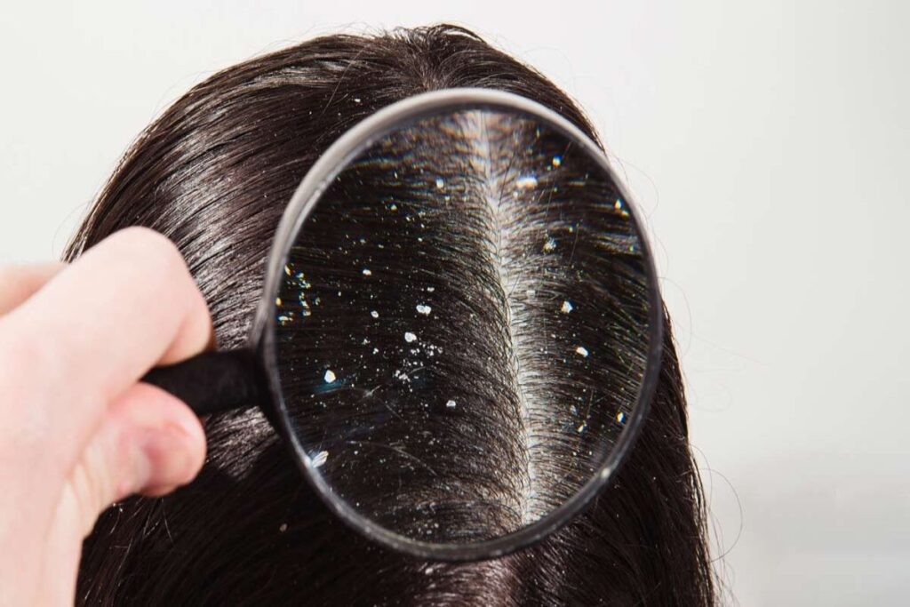 Anti-Dandruff Hair Mask