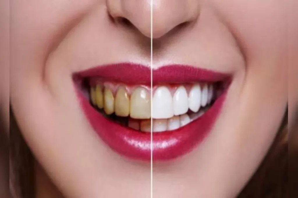 How to get rid of yellow teeth