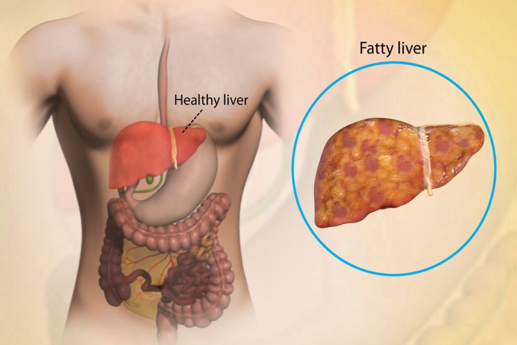 Liver Fat