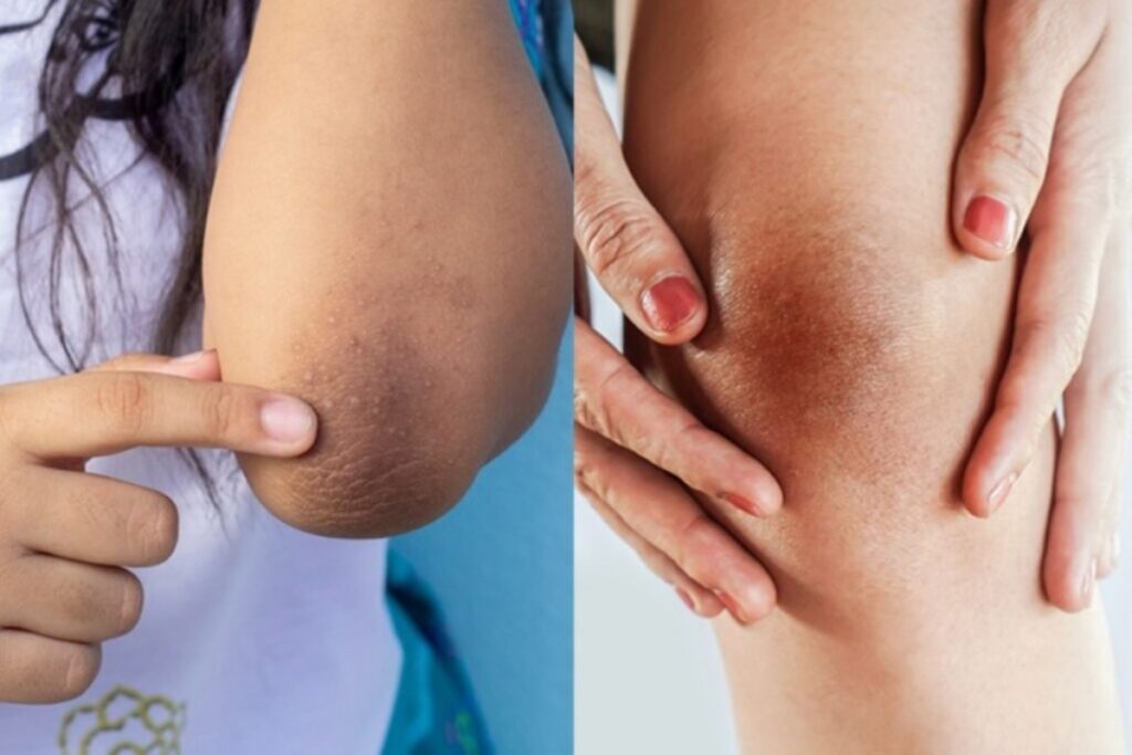Home Remedies For Dark Elbows And Knees