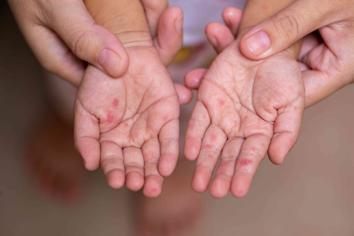 छोटे बच्चों में तेजी से फैल रही HFMD बीमारी, जानें क्या हैं इसके लक्षण?