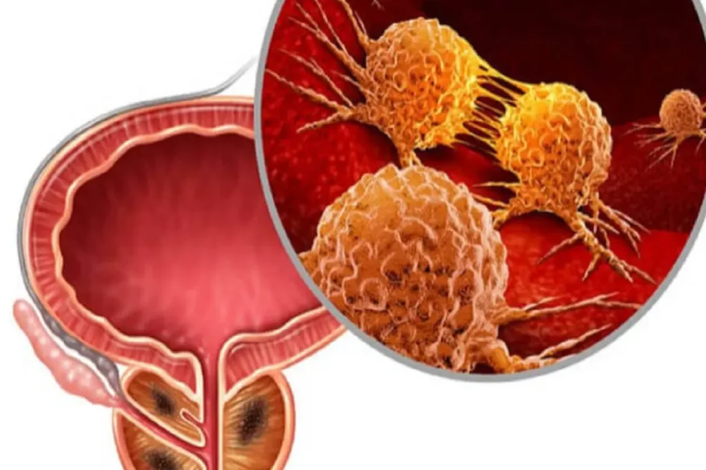 Prostate Cancer