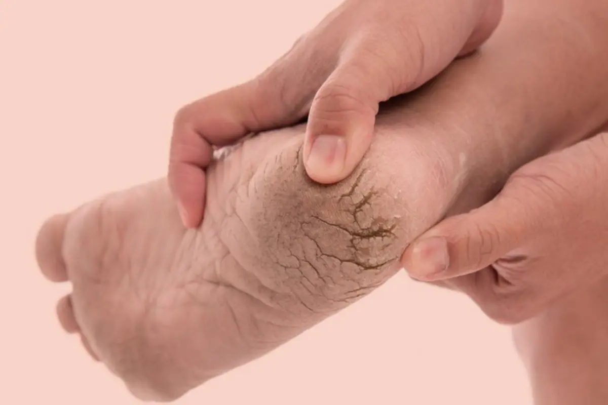 Home remedies for cracked heels