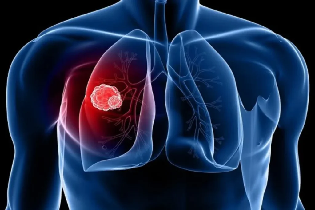 Lung Cancer Reason