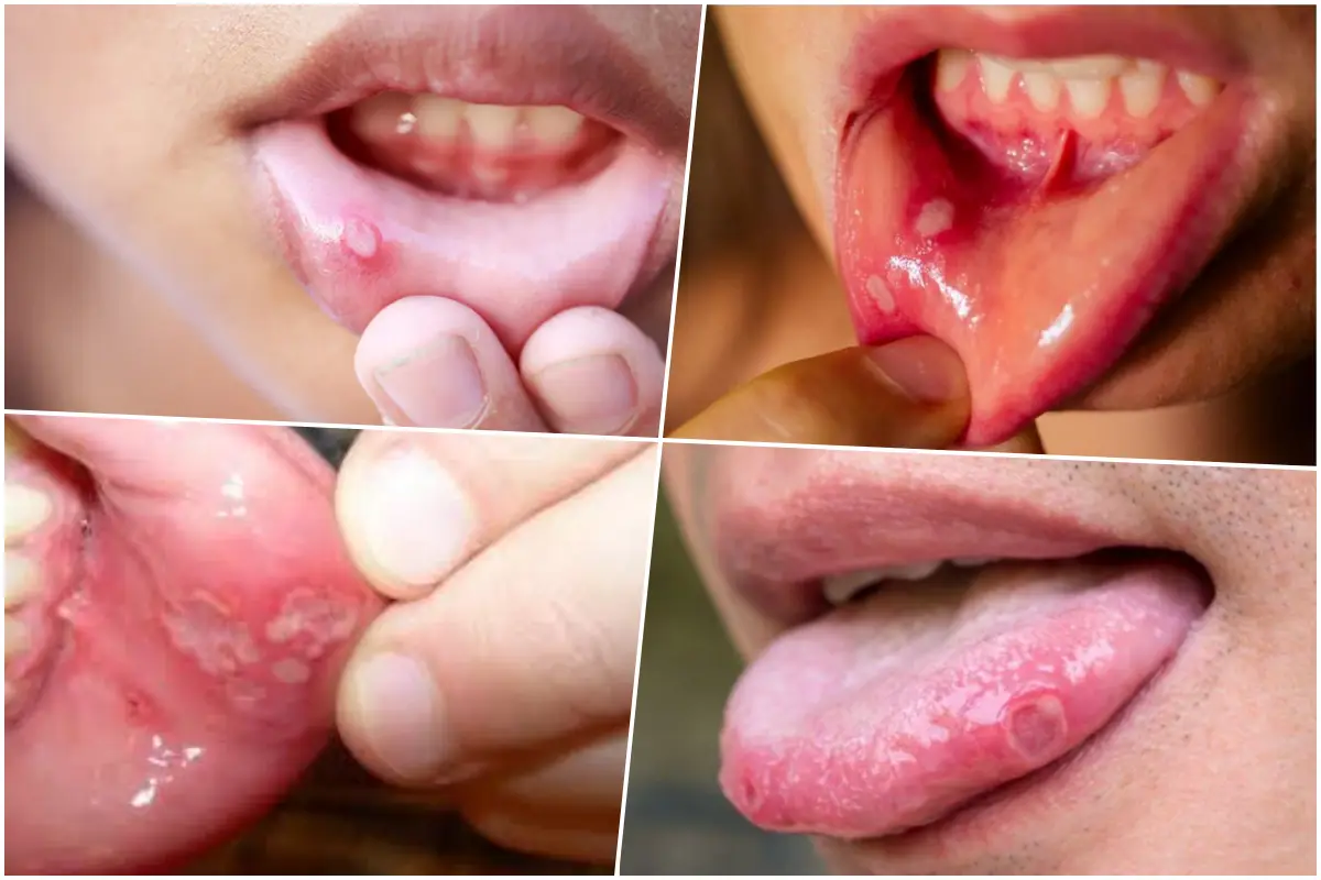 Mouth Ulcers