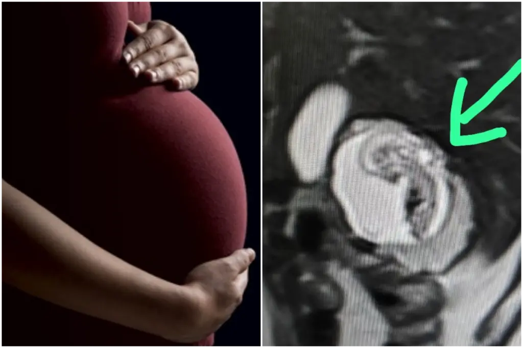 Bulandshahr-rare pregnancy
