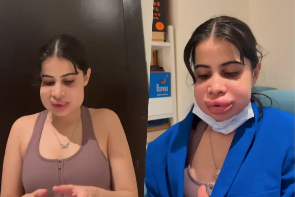 Urfi Javed’s lip filler