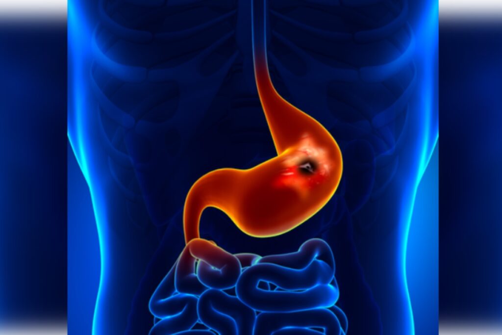 Ulcer Remedies