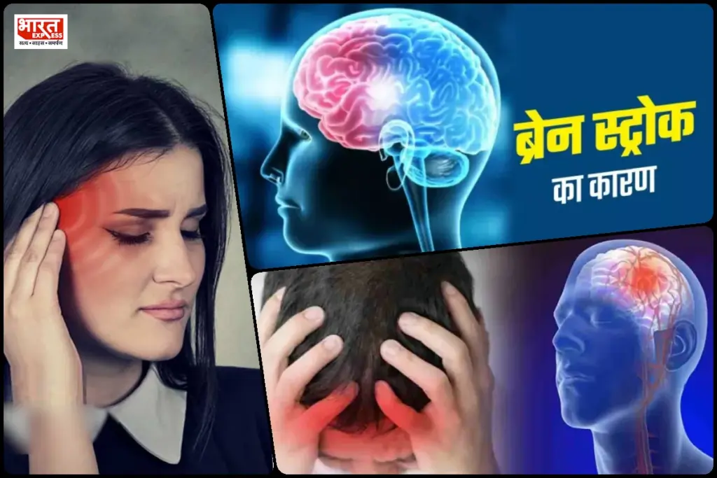 Brain Stroke