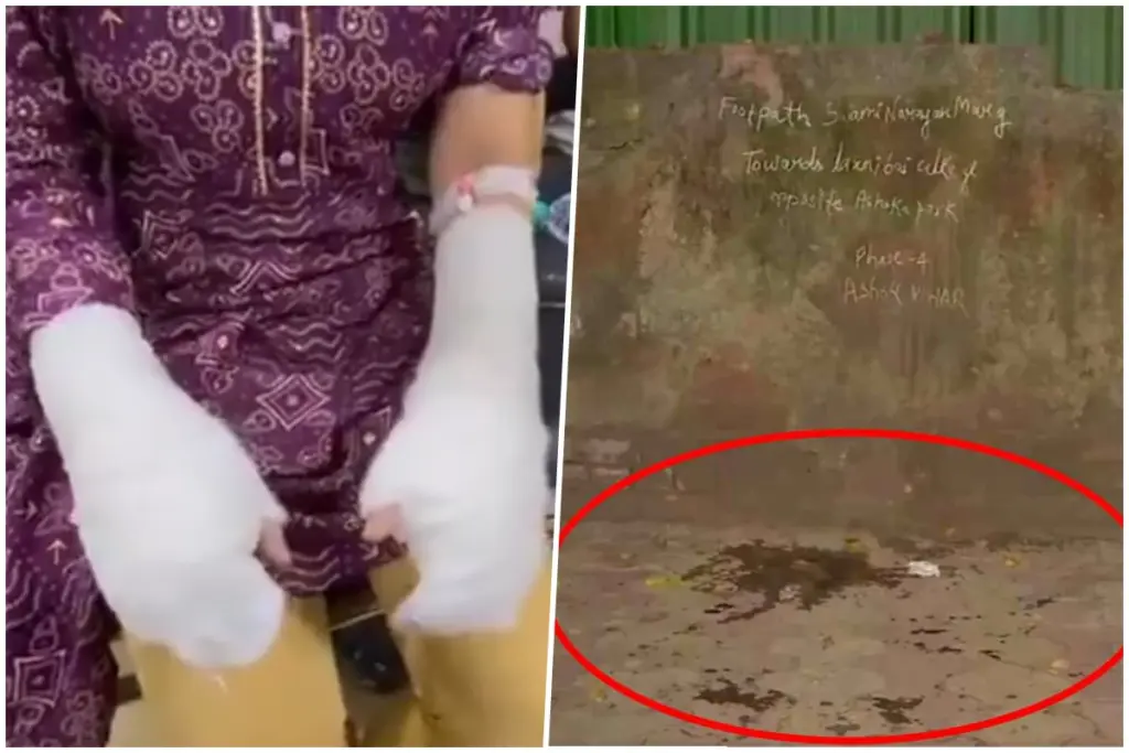 Delhi University Student Acid Attack