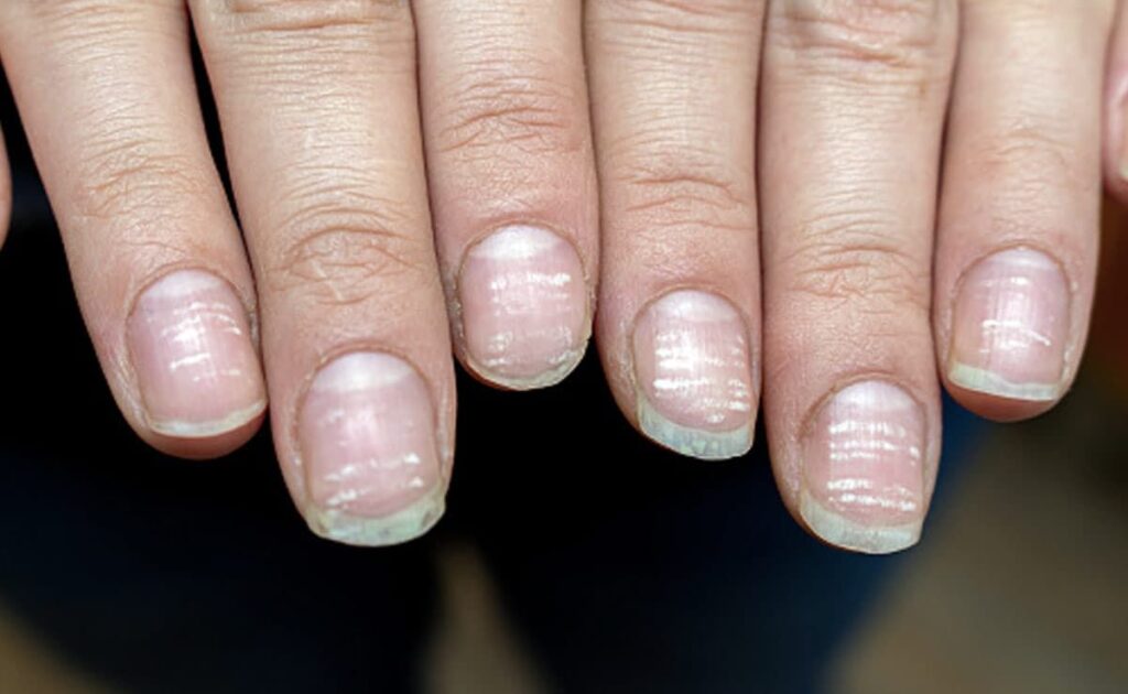 Nail Fungus Warning