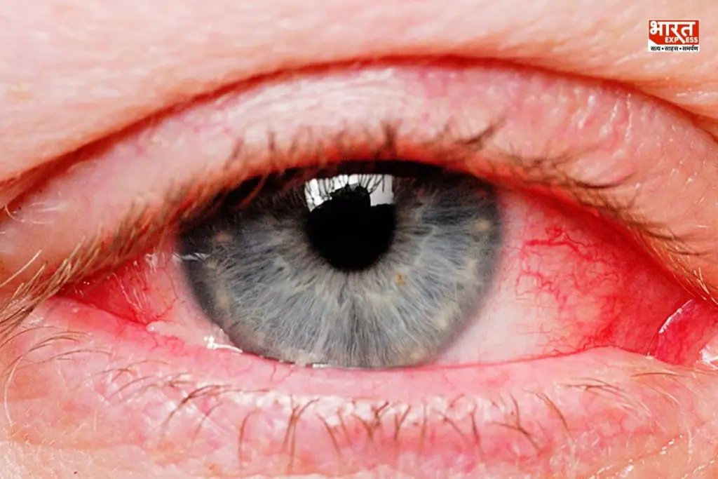 Red Eyes Causes Low Screen Time