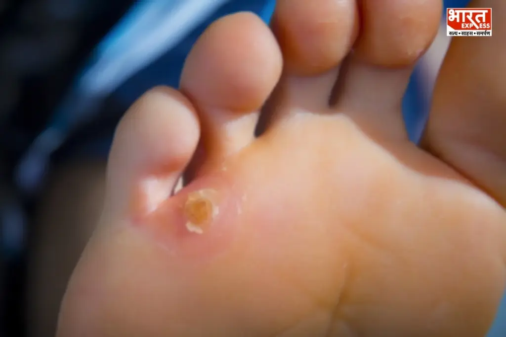  Foot Corn Treatment at Home